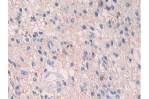 Detection of HIF1a in Human Glioma Tissue using Polyclonal Antibody to Hypoxia Inducible Factor 1 Alpha (HIF1a)