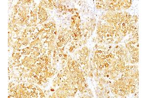 Formalin-fixed, paraffin-embedded human Melanoma stained with Melan-A Monoclonal Antibody (M2-9E3). (MLANA anticorps)
