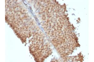 Formalin-fixed, paraffin-embedded human Bladder Carcinoma stained with ER-beta1 Mouse Monoclonal Antibody (ERb455). (ESR2 anticorps  (C-Term))