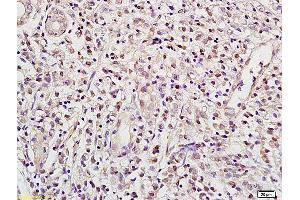 Formalin-fixed and paraffin embedded human gastric carcinoma labeled with Anti RBPJK RBP-J Polyclonal Antibody, unconjugated (ABIN872972) at 1:200 followed by incubation with conjugated secondary antibody and DAB staining (RBPJ anticorps  (AA 101-200))