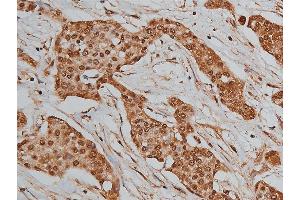 ABIN6268699 at 1/200 staining human liver cancer tissue sections by IHC-P.