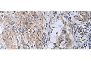 Immunohistochemistry of paraffin-embedded Human esophagus cancer tissue using MBL2 Polyclonal Antibody at dilution of 1:25(x200)