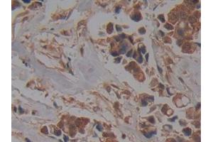 DAB staining on IHC-P; Samples: Human Breast cancer Tissue (NUP37 anticorps  (AA 34-279))