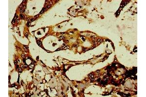 Immunohistochemistry of paraffin-embedded human pancreatic cancer using ABIN7167883 at dilution of 1:100 (Retrotransposon Gag-Like Protein 8B (RTL8C) (AA 1-113) anticorps)