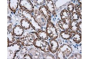 Immunohistochemical staining of paraffin-embedded Carcinoma of liver tissue using anti-RC201933 mouse monoclonal antibody. (PIM2 anticorps)