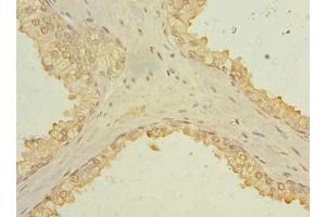 Immunohistochemistry of paraffin-embedded human prostate cancer using ABIN7173631 at dilution of 1:100 (TSACC/C1orf182 anticorps  (AA 1-125))