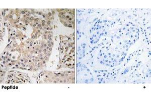 Immunohistochemistry analysis of paraffin-embedded human breast carcinoma tissue, using MRPL41 polyclonal antibody . (MRPL41 anticorps)