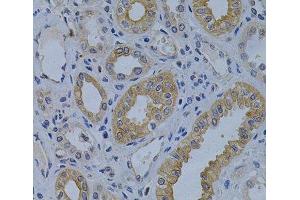 Immunohistochemistry of paraffin-embedded Human kidney cancer using MVP Polyclonal Antibody at dilution of 1:200 (40x lens). (MVP anticorps)