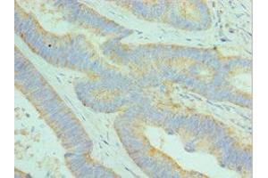 Immunohistochemistry of paraffin-embedded human colon cancer using ABIN7149525 at dilution of 1:100 (DCAF7 anticorps  (AA 1-342))
