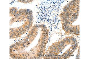 Immunohistochemistry of Human cervical cancer using SIPA1 Polyclonal Antibody at dilution of 1:40 (SIPA1 anticorps)
