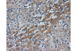 Immunohistochemical staining of paraffin-embedded Carcinoma of liver tissue using anti-LIPG mouse monoclonal antibody. (LIPG anticorps)