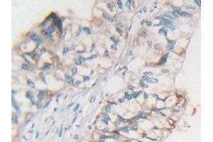 IHC-P analysis of Human Rectum Cancer Tissue, with DAB staining. (MSTN anticorps  (AA 266-375))