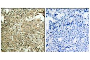 Immunohistochemical analysis of paraffin-embedded human breast carcinoma tissue using cofilin(Phospho-Ser3) Antibody(left) or the same antibody preincubated with blocking peptide(right).