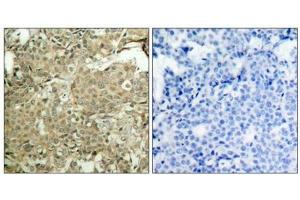 Immunohistochemical analysis of paraffin-embedded human breast carcinoma tissue using cofilin(Phospho-Ser3) Antibody(left) or the same antibody preincubated with blocking peptide(right). (Cofilin anticorps  (pSer3))