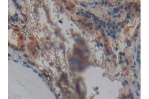 Detection of SNCG in Human Thyroid Tissue using Polyclonal Antibody to Gamma-synuclein (SNCG)