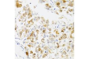 Immunohistochemistry of paraffin-embedded human liver cancer using MYO5A antibody. (MYO5A anticorps)