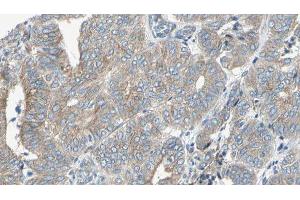 ABIN6276702 at 1/100 staining Human cervical cancer tissue by IHC-P. (NQO1 anticorps  (C-Term))