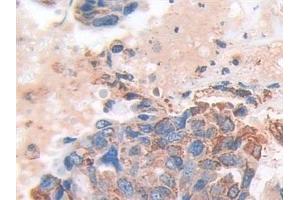 Detection of SOD2 in Human Breast cancer Tissue using Polyclonal Antibody to Superoxide Dismutase 2, Mitochondrial (SOD2) (SOD2 anticorps  (AA 25-222))