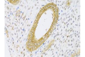 Immunohistochemistry of paraffin-embedded human adenomyosis using RAB27A Antibody (ABIN5970998) at dilution of 1/100 (40x lens). (RAB27A anticorps)