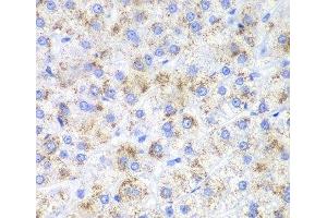Immunohistochemistry of paraffin-embedded Human liver cancer using HAO1 Polyclonal Antibody at dilution of 1:200 (40x lens). (HAO1 anticorps)