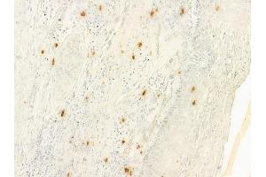 ABIN6261092 and ABIN6277988 at 1/100 staining human cervical carcinoma by IHC-P. (CTNNBL1 anticorps  (N-Term))
