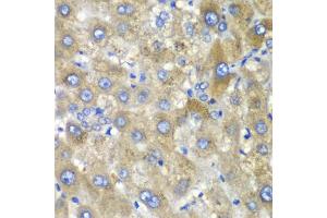 Immunohistochemistry of paraffin-embedded human liver injury using TLK2 antibody (ABIN5974098) at dilution of 1/100 (40x lens). (TLK2 anticorps)