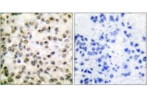 Immunohistochemistry analysis of paraffin-embedded human breast carcinoma tissue, using CREB-BP Antibody. (CBP anticorps  (AA 2393-2442))