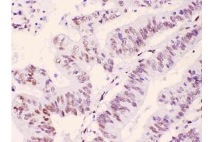 PML Protein was detected in paraffin-embedded sections of human intetsinal cancer tissues using rabbit anti- PML Protein Antigen Affinity purified polyclonal antibody (Catalog # ) at 1 ?