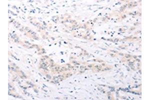 The image on the left is immunohistochemistry of paraffin-embedded Human colon cancer tissue using ABIN7131156(SPATA16 Antibody) at dilution 1/25, on the right is treated with fusion protein. (SPATA16 anticorps)