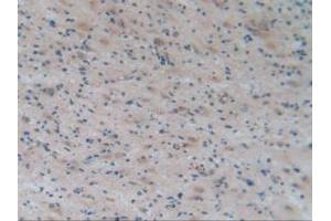 IHC-P analysis of Human Glioma Tissue, with DAB staining. (APOA2 anticorps  (AA 24-100))