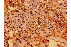 Immunohistochemistry of paraffin-embedded human cervical cancer using ABIN7172818 at dilution of 1:100