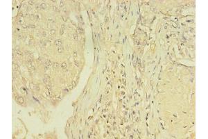 Immunohistochemistry of paraffin-embedded human lung cancer using ABIN7172152 at dilution of 1:100