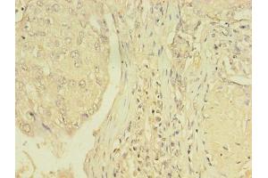 Immunohistochemistry of paraffin-embedded human lung cancer using ABIN7172152 at dilution of 1:100 (THRB anticorps  (AA 1-461))
