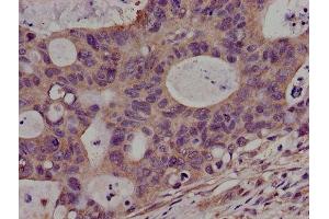 Immunohistochemistry of paraffin-embedded human colon cancer using ABIN7169080 at dilution of 1:100 (PKN2 anticorps  (AA 925-969))