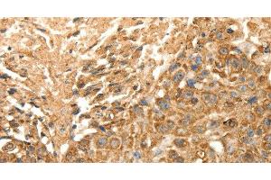 Immunohistochemistry of paraffin-embedded Human esophagus cancer using SLC25A11 Polyclonal Antibody at dilution of 1:30 (SLC25A11 anticorps)