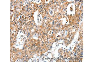 Immunohistochemistry of Human lung cancer using BAX Polyclonal Antibody at dilution of 1:30 (BAX anticorps)