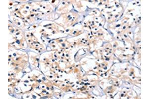 The image on the left is immunohistochemistry of paraffin-embedded Human thyroid cancer tissue using ABIN7128792(CATSPER1 Antibody) at dilution 1/40, on the right is treated with fusion protein. (CATSPER1 anticorps)