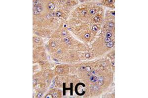 Formalin-fixed and paraffin-embedded human hepatocellular carcinoma reacted with FUCA2 polyclonal antibody  , which was peroxidase-conjugated to the secondary antibody, followed by DAB staining. (FUCA2 anticorps  (N-Term))