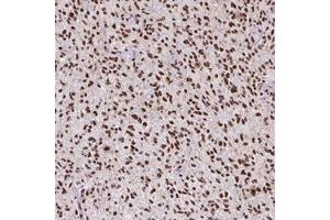 Immunohistochemical staining (Formalin-fixed paraffin-embedded sections) of human glioma with ATRX monoclonal antibody, clone CL0537  shows strong nuclear positivity in tumor cells. (ATRX anticorps)