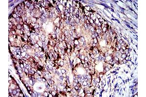 Immunohistochemical analysis of paraffin-embedded cervical cancer tissues using CD107b mouse mAb with DAB staining.