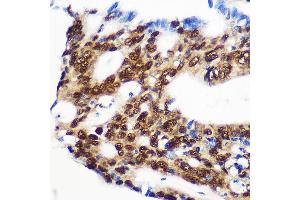 Immunohistochemistry of paraffin-embedded Human colon carcinoma using RBM15 Rabbit pAb (ABIN1682491, ABIN3019286, ABIN3019287, ABIN5664924 and ABIN6220805) at dilution of 1:100 (40x lens). (RBM15 anticorps  (AA 530-780))