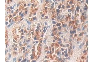 Detection of KLK11 in Human Prostate cancer Tissue using Polyclonal Antibody to Kallikrein 11 (KLK11) (Kallikrein 11 anticorps  (AA 39-282))