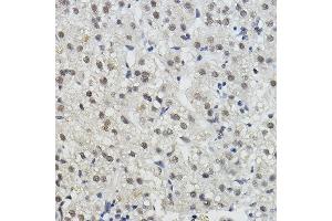 Immunohistochemistry of paraffin-embedded human liver cancer using BRAP Rabbit pAb (ABIN7265922) at dilution of 1:100 (40x lens). (BRAP anticorps  (AA 1-200))