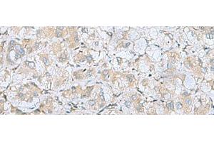 Immunohistochemistry of paraffin-embedded Human liver cancer tissue using BDNF Polyclonal Antibody at dilution of 1:65(x200) (BDNF anticorps)
