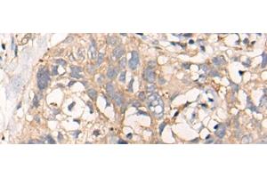 Immunohistochemistry of paraffin-embedded Human lung cancer tissue using NREP Polyclonal Antibody at dilution of 1:35(x200) (NREP anticorps)