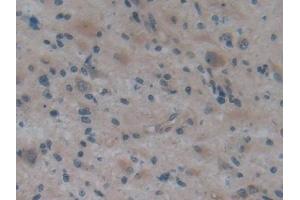 Detection of APOA2 in Human Glioma Tissue using Polyclonal Antibody to Apolipoprotein A2 (APOA2)