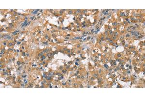 Immunohistochemistry of paraffin-embedded Human thyroid cancer using PLEKHO1 Polyclonal Antibody at dilution of 1:70 (PLEKHO1 anticorps)
