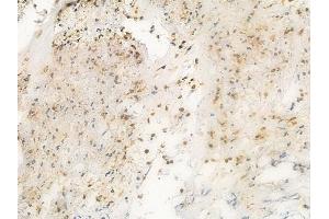 ABIN6260927 and ABIN6269194 at 1/100 staining human breast carcinoma by IHC-P. (Cofilin anticorps  (N-Term))