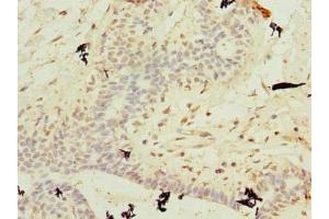 Immunohistochemistry of paraffin-embedded human breast cancer using ABIN7174699 at dilution of 1:100 (AKNA Domain Containing 1 (AKNAD1) (AA 1-223) anticorps)