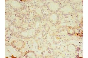 Immunohistochemistry of paraffin-embedded human breast cancer using ABIN7157249 at dilution of 1:100 (KBTBD4 anticorps  (AA 151-415))